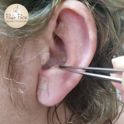 técnicas-auriculoterapia-paceacupuntura