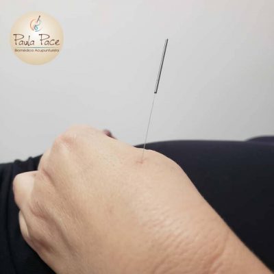 técnicas-acupunturamão-paceacupuntura