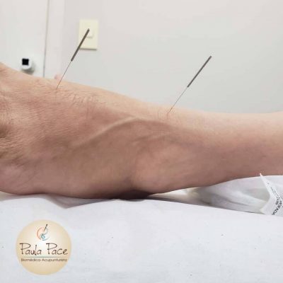 técnicas-acupunturapé-paceacupuntura